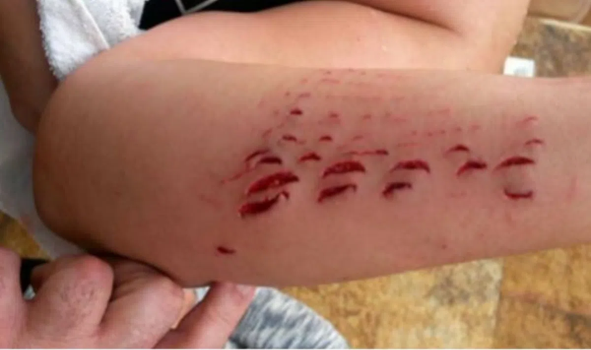 На Канарах акула покусала туристку